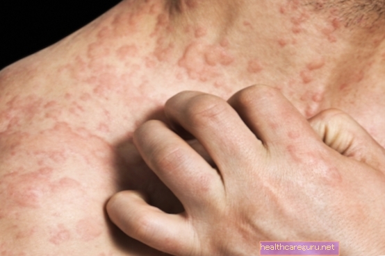 Κρύα αλλεργία: τι είναι, κύρια συμπτώματα και θεραπεία