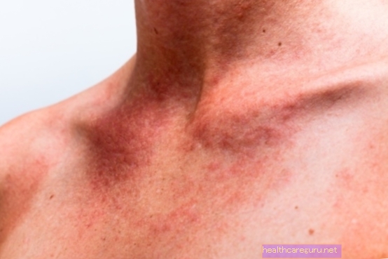 Solcreme allergi: symptomer og hvad man skal gøre