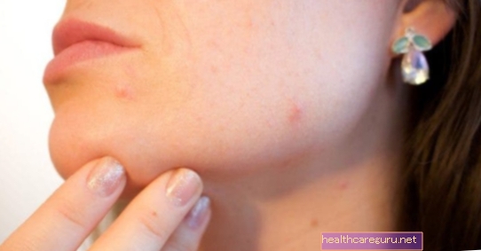 Kožna alergija: glavni vzroki in način zdravljenja