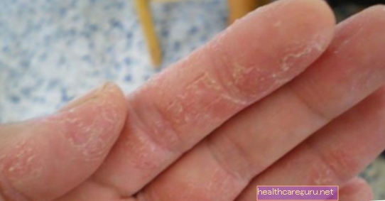 손의 알레르기 : 원인, 증상 및 치료