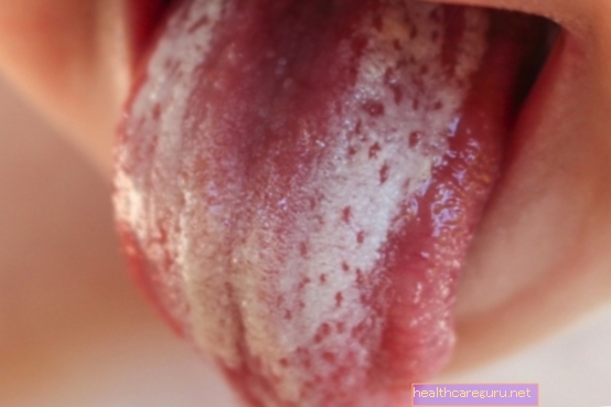 Jak používat "nystatinový gel" k léčbě afty v ústech