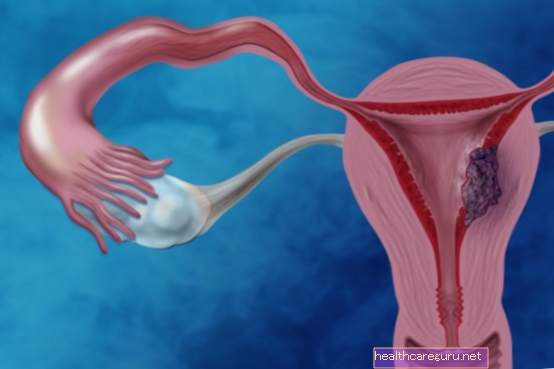 Endometriumkarzinom: Was es ist, Hauptsymptome und wie zu behandeln