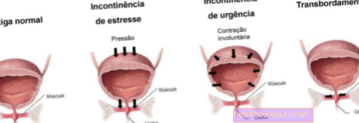 Stresna inkontinenca: kaj je, vzroki in zdravljenje