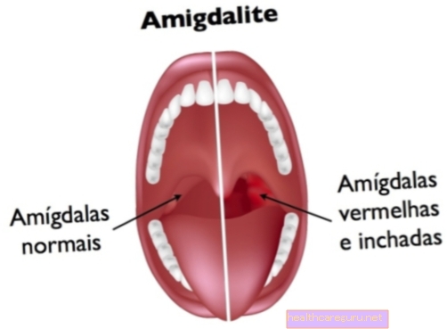 Vad är viral tonsillit, symtom och behandling