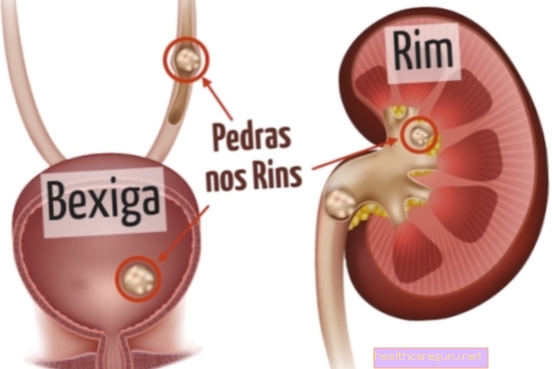 Piatra la rinichi: cauze, simptome și modul de eliminare