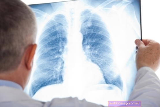 المتلازمة التنفسية الحادة الوخيمة (سارس): ما هي ، الأعراض والعلاج