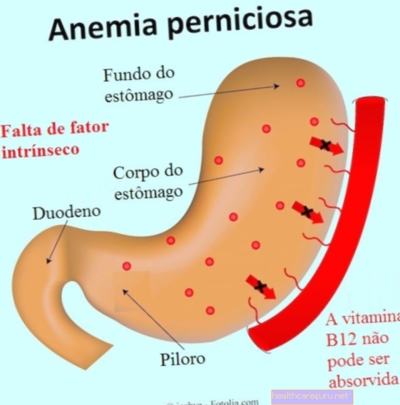 Pernicious anēmija: simptomi, diagnostika un ārstēšana