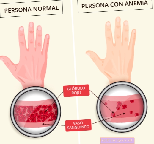 Kako zdraviti megaloblastično anemijo