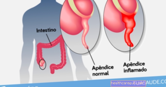Appendicitis: Hvad det er, symptomer og behandling
