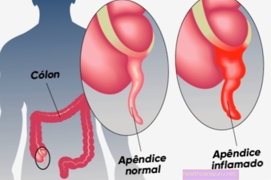 Какво е остър апендицит и основни симптоми