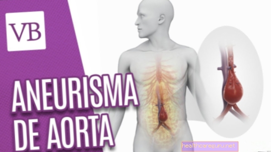 Aneurisma aorta: apa itu, gejala, rawatan dan pembedahan