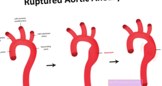 Aorta ektāzija: kas tas ir, kādi ir simptomi un kā ārstēt