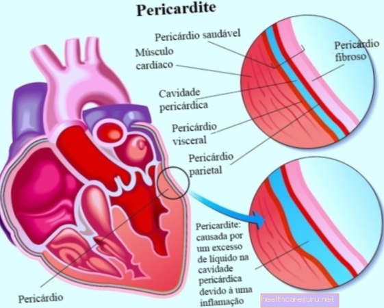 Chronická perikarditida: co to je, příznaky a příčiny