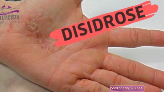 Dishidroza: kaj je to, vzroki in oblike zdravljenja