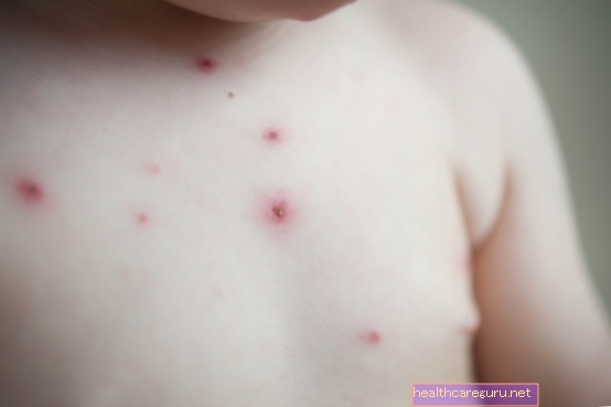 Kožní infekce: hlavní typy, příznaky a léčba