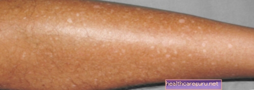 Leucoderma gutata (baltas vasaras raibumi): kas tas ir un kā ārstēt
