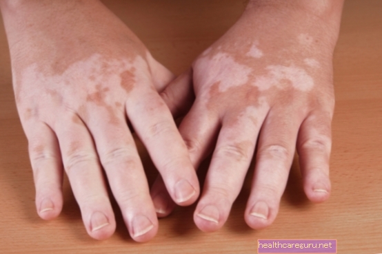 Co může způsobit Vitiligo a jak se léčit