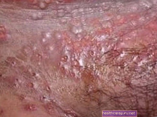 Genitální herpes příznaky a léky používané při léčbě