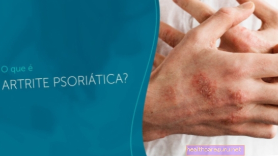 Artritis psoriatica: wat het is, symptomen en behandeling