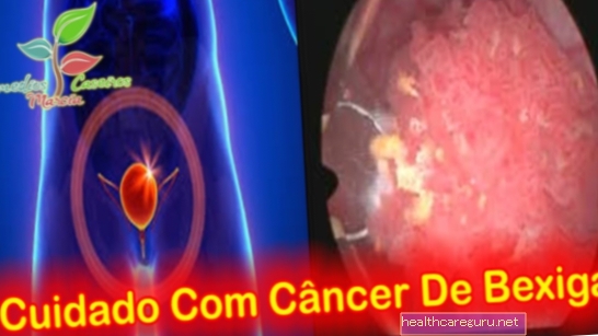 อาการมะเร็งกระเพาะปัสสาวะสาเหตุหลักและวิธีการรักษา