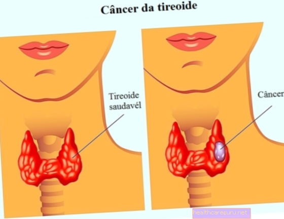 Simptom sista tiroid dan bagaimana rawatan dilakukan