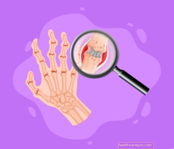 Ревматоиден артрит - какви са симптомите и как да се лекува