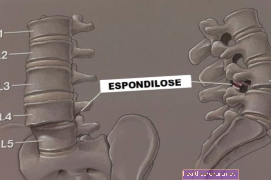Spondyloarthrose lombaire: qu'est-ce que c'est, symptômes et traitement