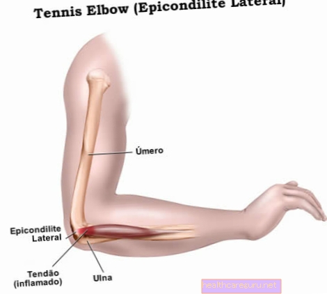 Kaj je lateralni epikondilitis, simptomi in kako zdraviti