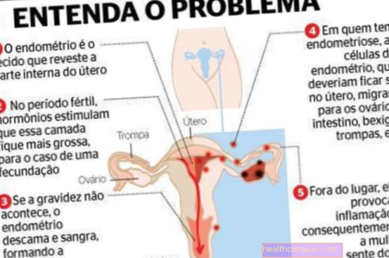 Endometrioze olnīcā: kas tas ir, simptomi un ārstēšana
