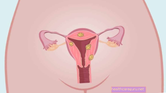Menstruacija sa ugrušcima: 7 glavnih uzroka i što učiniti