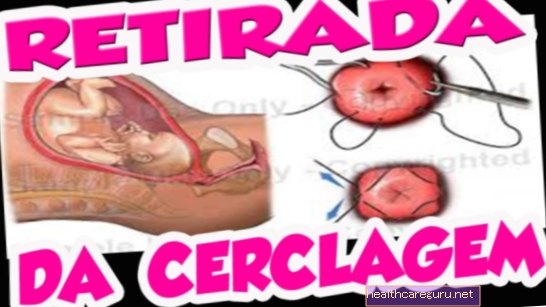 Uteriene cerclage: wat is een operatie en hoe wordt deze uitgevoerd om de baby vast te houden