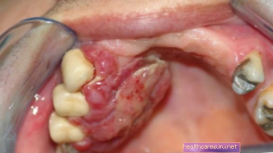 Kanser mulut: apa itu, gejala, sebab dan rawatan