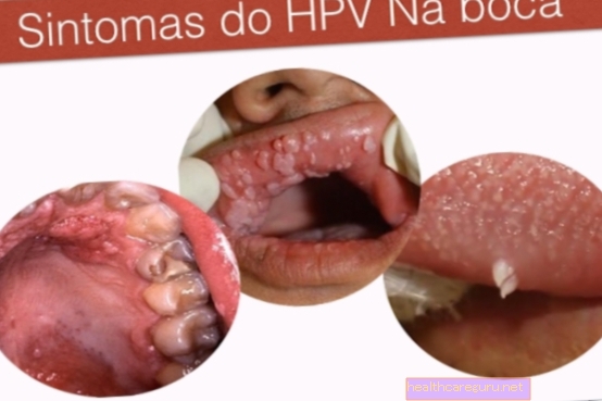 HPV în gură: simptome, tratament și căi de transmitere