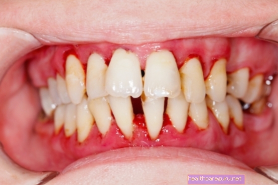 Apa itu periodontitis, gejala dan rawatan