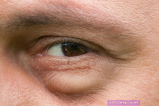 Alergija na oči: glavni uzroci, simptomi i što učiniti