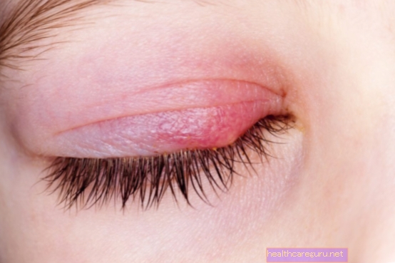Mikä on blefariitti (turvonnut silmäluomen) ja miten hoitaa