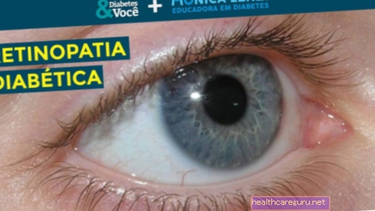 Hva er diabetisk retinopati, symptomer og hvordan behandlingen skal være