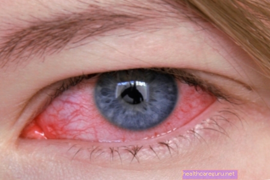 Mata merah: 9 sebab biasa dan apa yang perlu dilakukan
