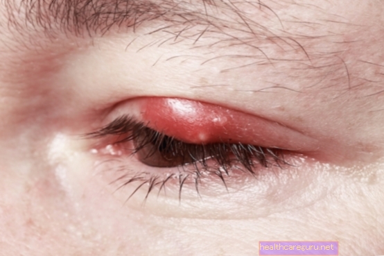 Opuchnuté oči a očné viečka: čo môže byť a ako liečiť