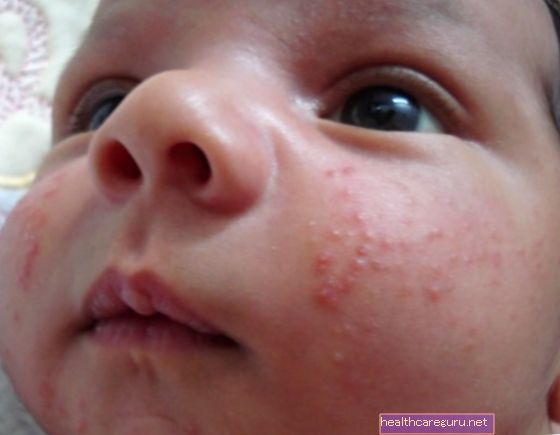 Neonatale acne: wat het is en hoe de puistjes bij de baby te behandelen