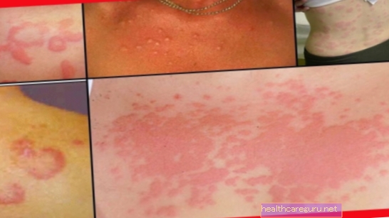 Alergija na otroško kožo: glavni vzroki, simptomi in kaj storiti