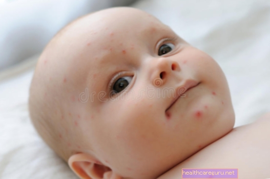 Симптоми на варицела при бебе, предаване и как да се лекува