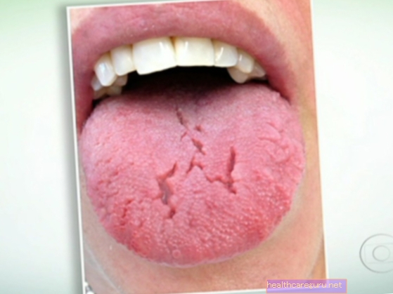 Hævet tunge: hvad det kan være, og hvad man skal gøre