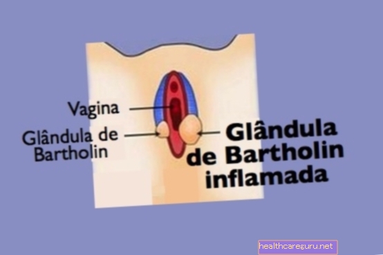 Bartholin cyste: årsaker, symptomer og behandling
