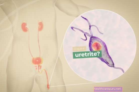 Uretritis: kaj je to, glavni simptomi in zdravljenje